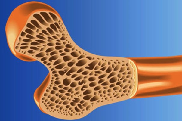 پوکی استخوان و راه های درمان آن